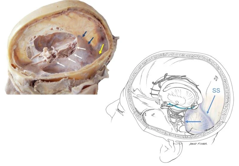 The Tentorium Cerebelli: A Comprehensive Review Including Its Anatomy ...